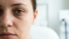 Miten pääset eroon tummista silmänalusista ilman kalliita voiteita – 7 asiantuntijan helppoa ohjetta